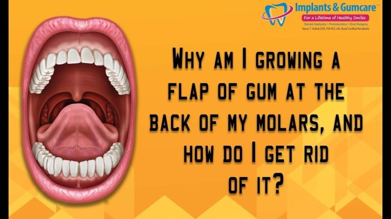 Understanding Gum Overgrowth on Back Teeth