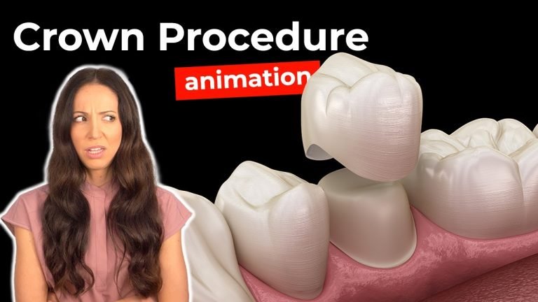 Timeframe for Dental Crown Placement: What to Expect
