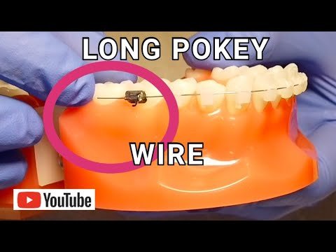 5 Easy Ways to Prevent Braces Wire from Poking Without Wax