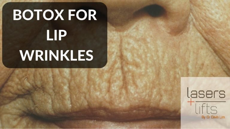 Upper Lip Botox: Before and After for Smoker's Lines
